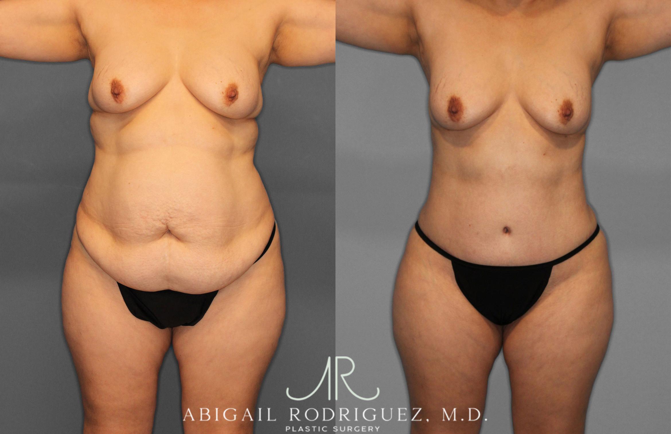 Before & After Tummy Tuck Case 258438 View 1 View in Houston, TX