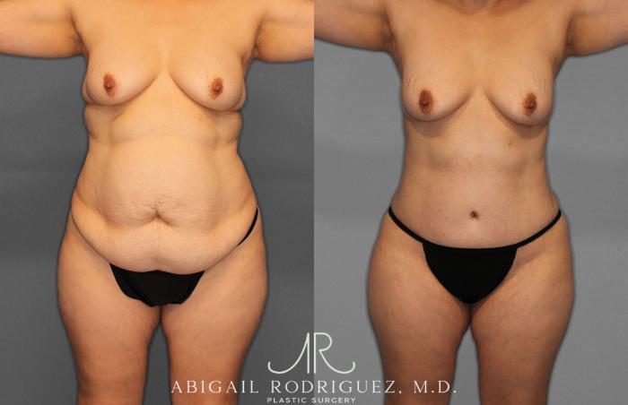 Before & After Tummy Tuck Case 258438 View 1 View in Houston, TX