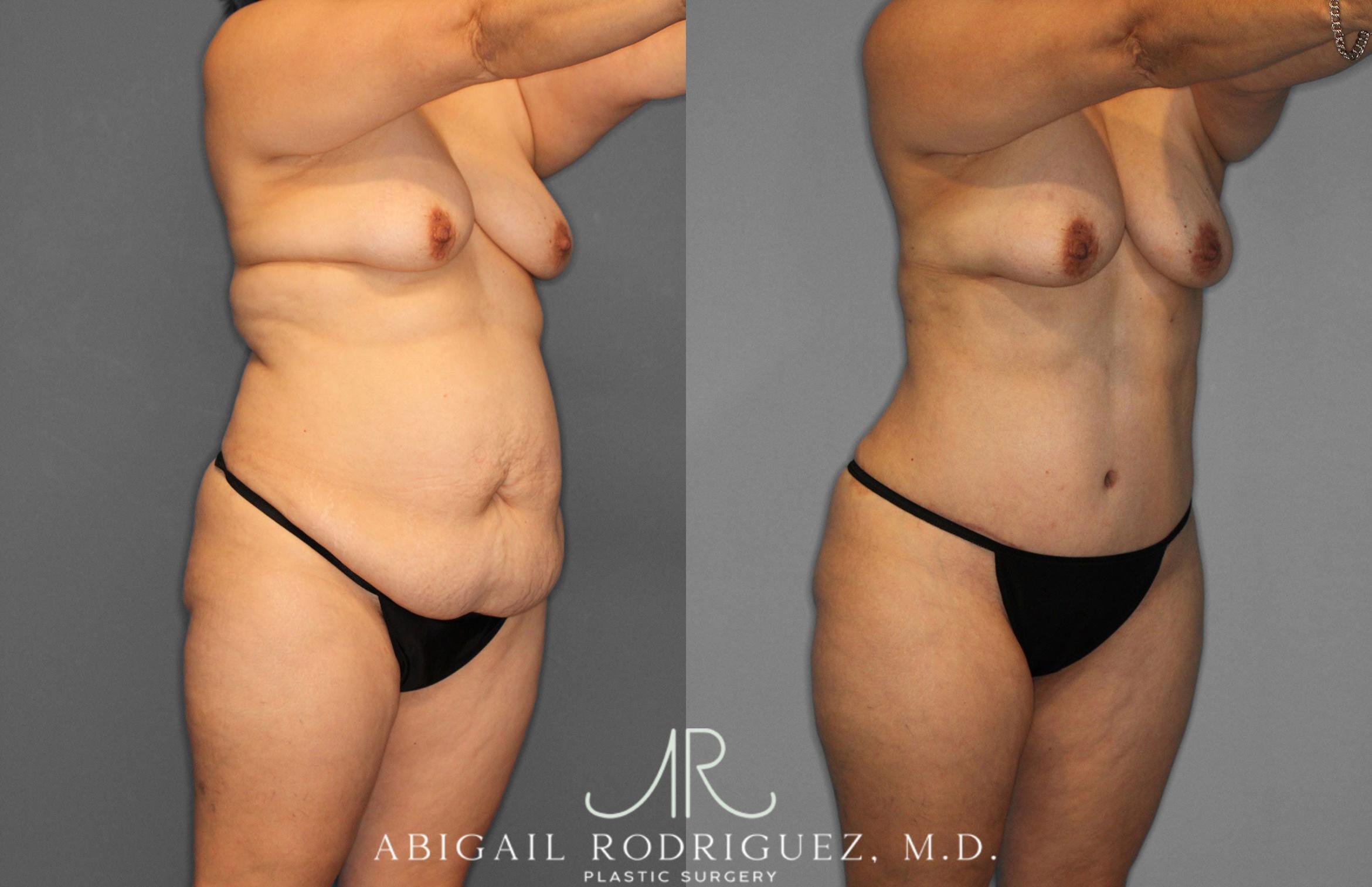 Before & After Tummy Tuck Case 258438 View 10 View in Houston, TX