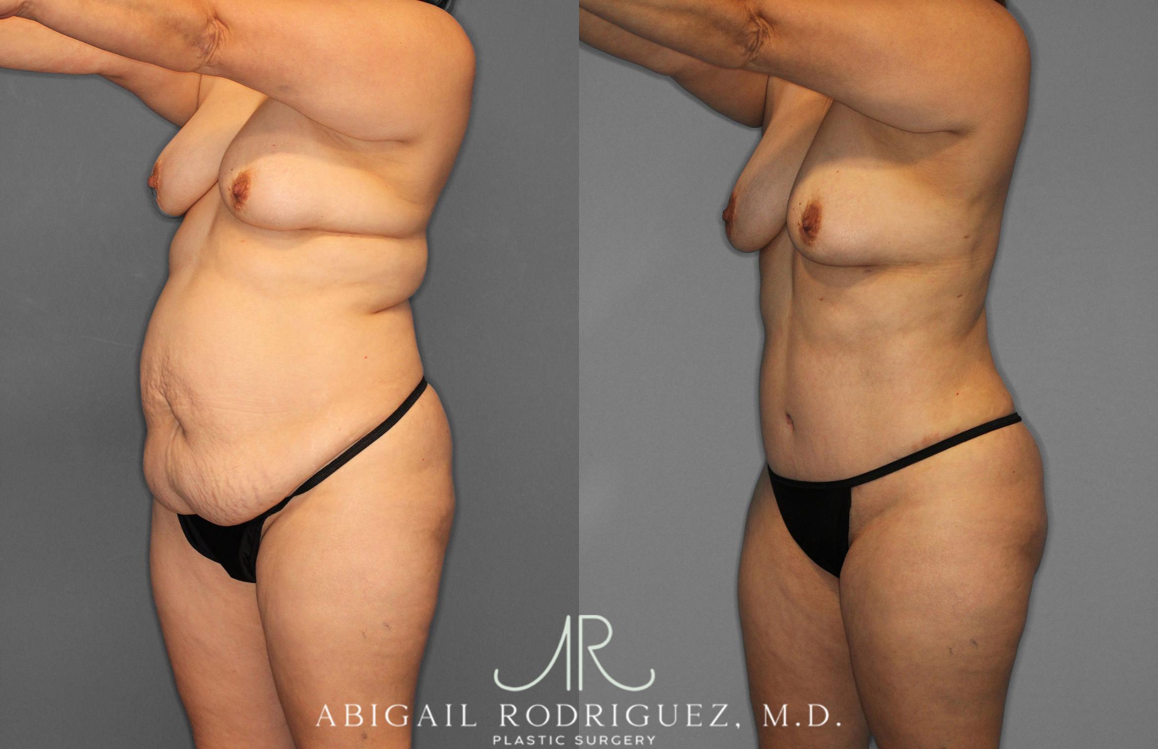 Before & After Tummy Tuck Case 258438 View 2 View in Houston, TX