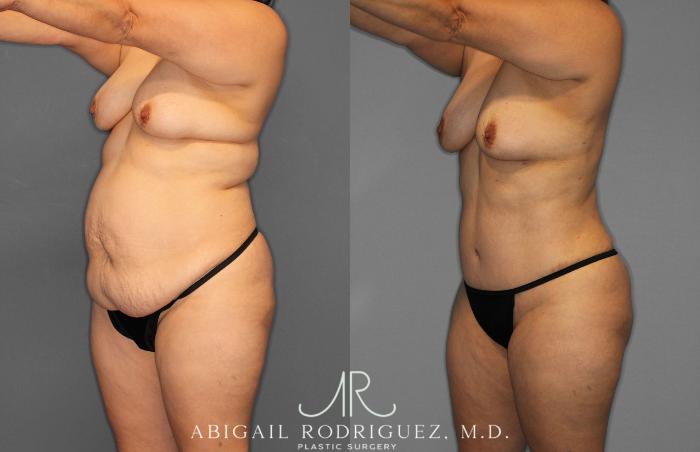 Before & After Tummy Tuck Case 258438 View 2 View in Houston, TX