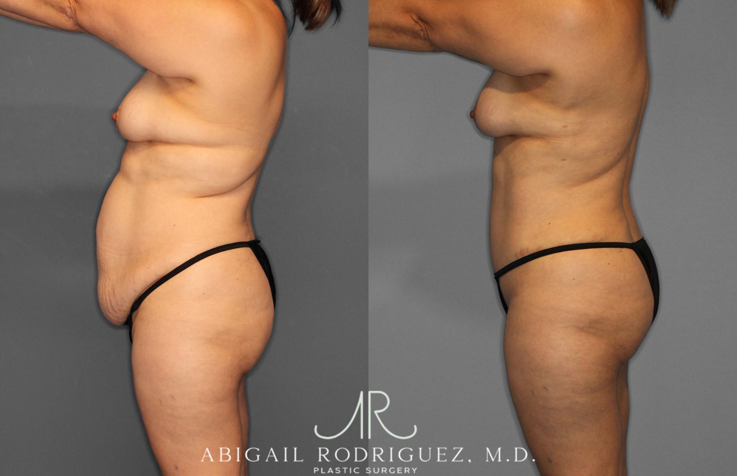 Before & After Tummy Tuck Case 258438 View 3 View in Houston, TX