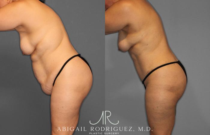 Before & After Tummy Tuck Case 258438 View 4 View in Houston, TX