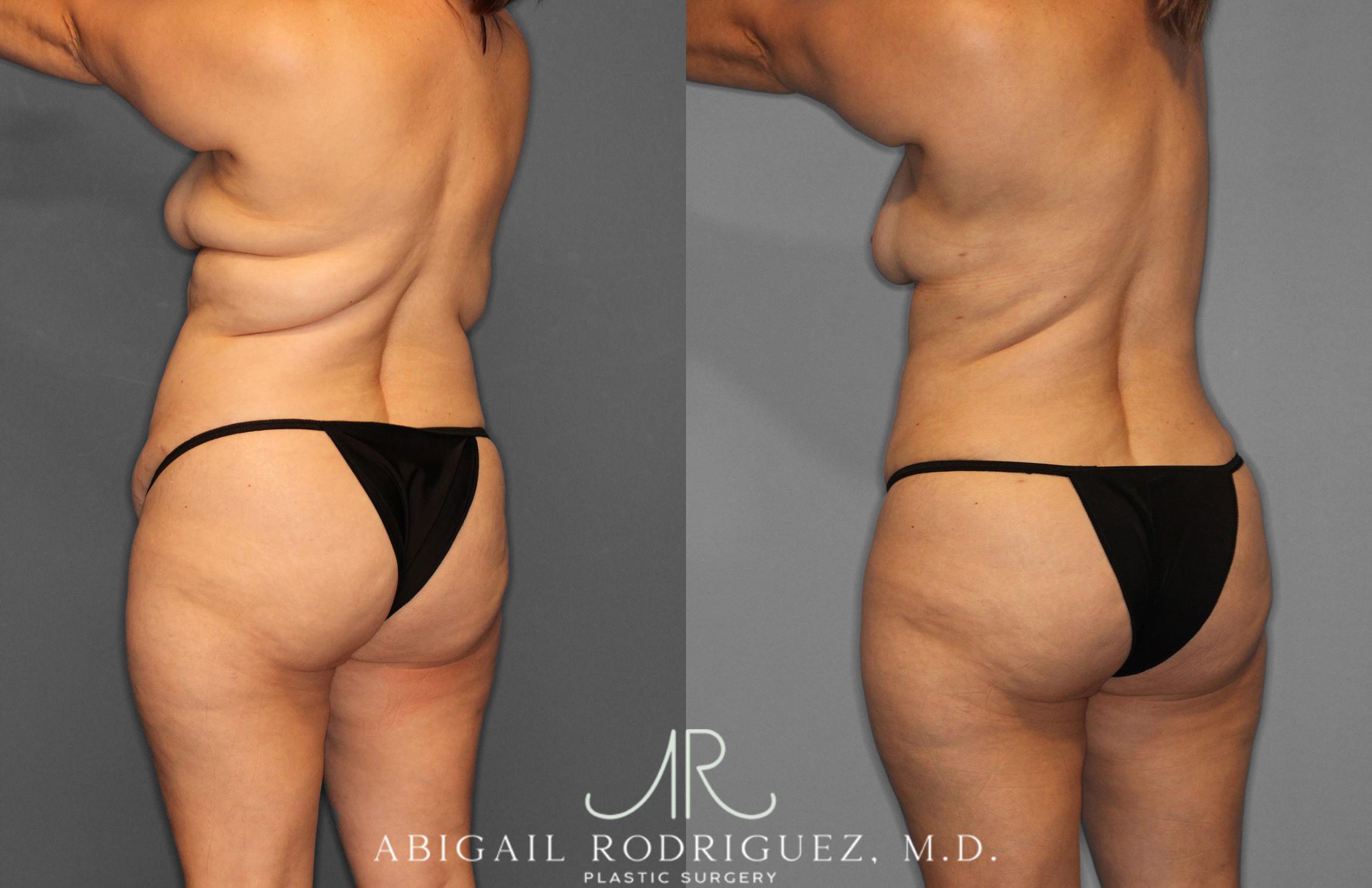 Before & After Tummy Tuck Case 258438 View 5 View in Houston, TX