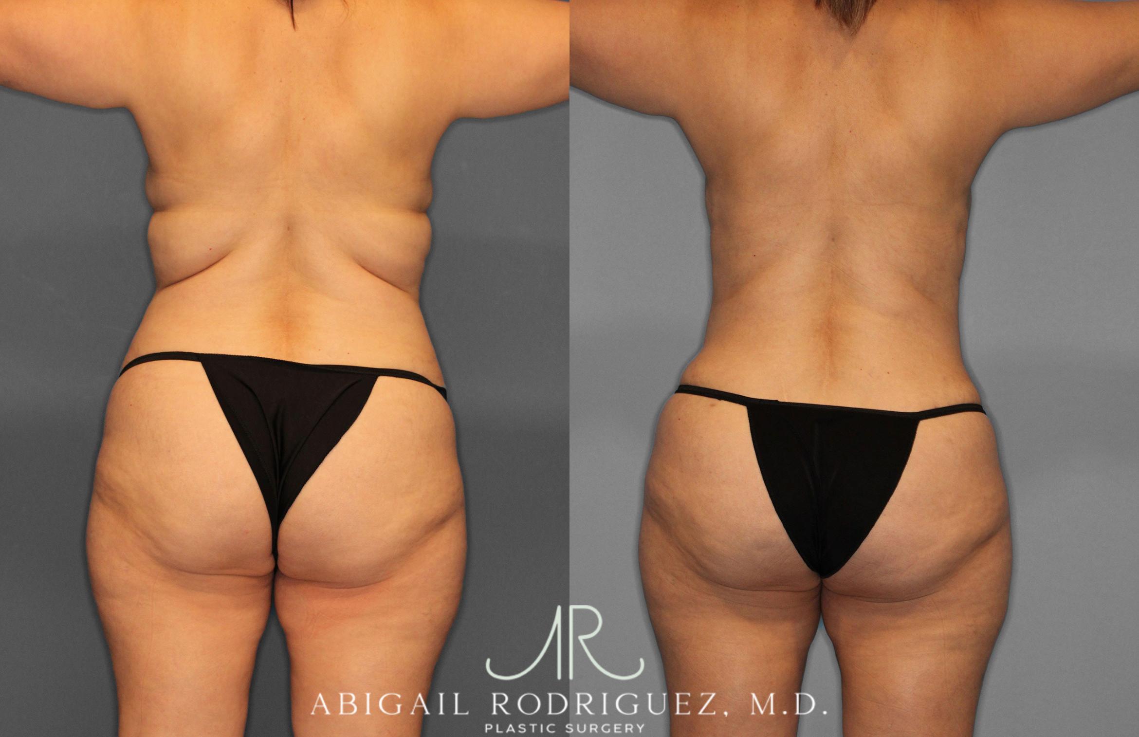 Before & After Tummy Tuck Case 258438 View 6 View in Houston, TX