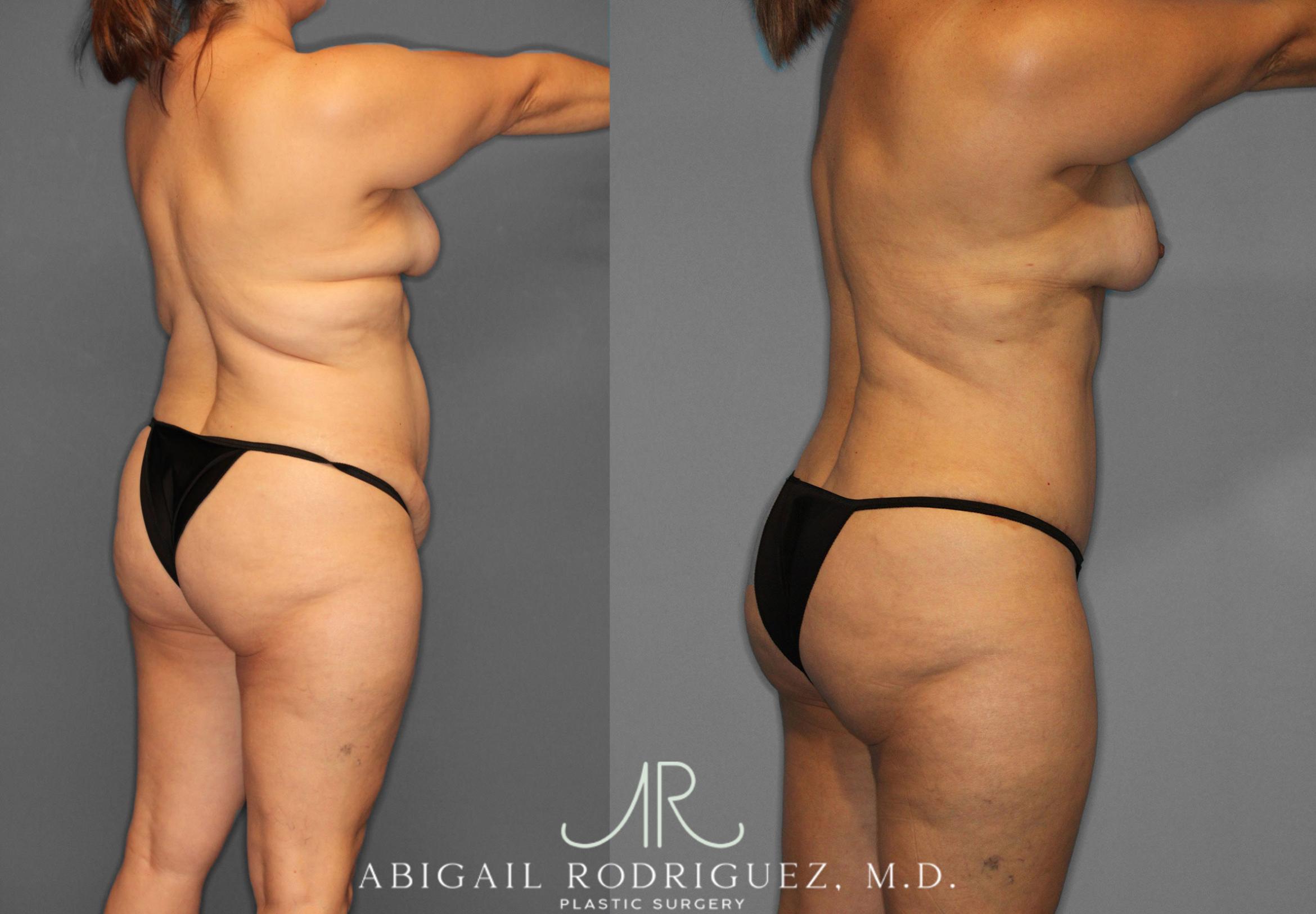 Before & After Tummy Tuck Case 258438 View 7 View in Houston, TX