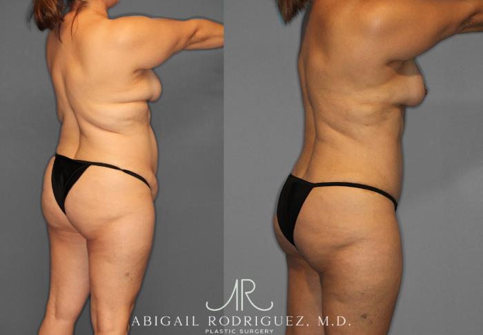 Before & After Tummy Tuck Case 258438 View 7 View in Houston, TX