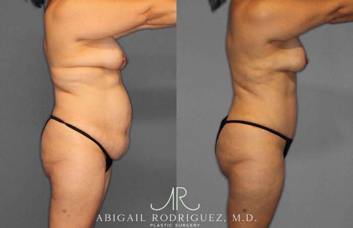 Before & After Tummy Tuck Case 258438 View 8 View in Houston, TX