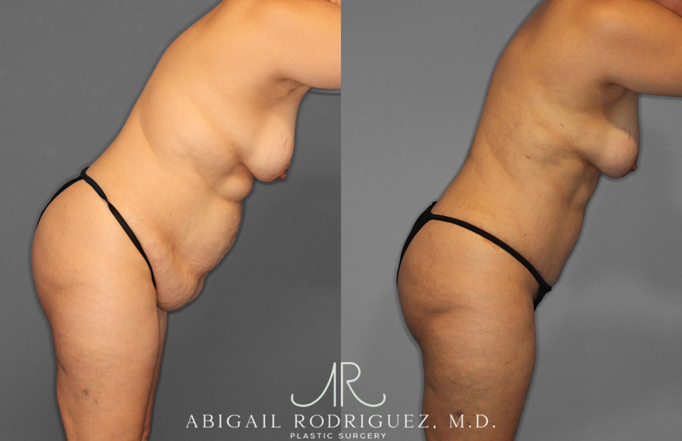 Before & After Tummy Tuck Case 258438 View 9 View in Houston, TX