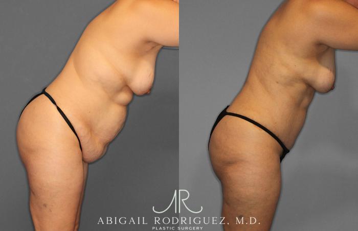 Before & After Tummy Tuck Case 258438 View 9 View in Houston, TX