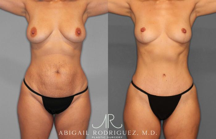 Before & After Tummy Tuck Case 258468 View 1 View in Houston, TX