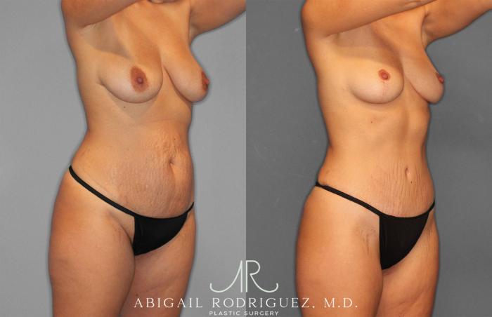 Before & After Tummy Tuck Case 258468 View 10 View in Houston, TX