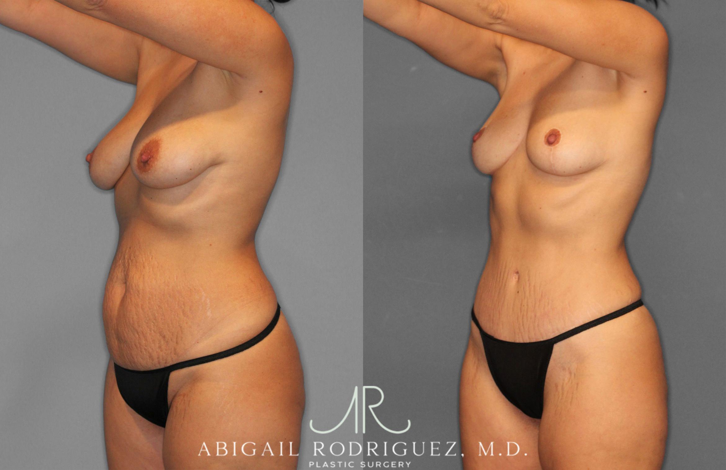 Before & After Tummy Tuck Case 258468 View 2 View in Houston, TX