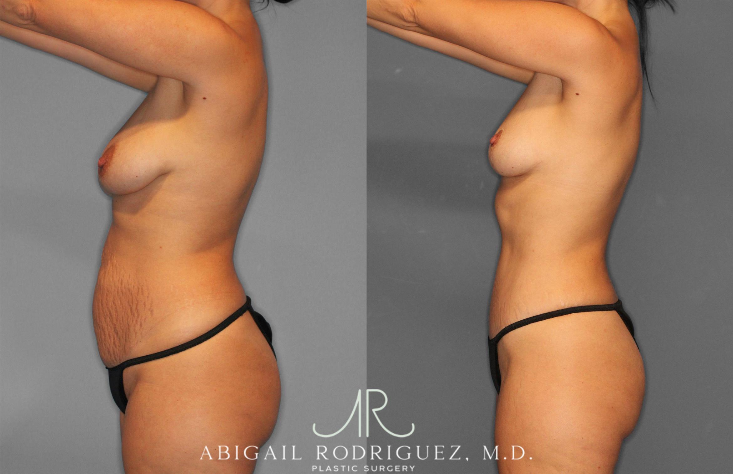 Before & After Tummy Tuck Case 258468 View 3 View in Houston, TX