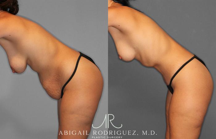 Before & After Tummy Tuck Case 258468 View 4 View in Houston, TX