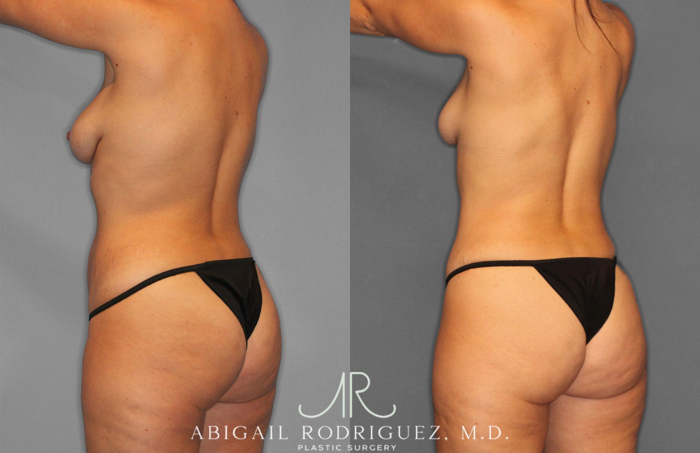 Before & After Tummy Tuck Case 258468 View 5 View in Houston, TX