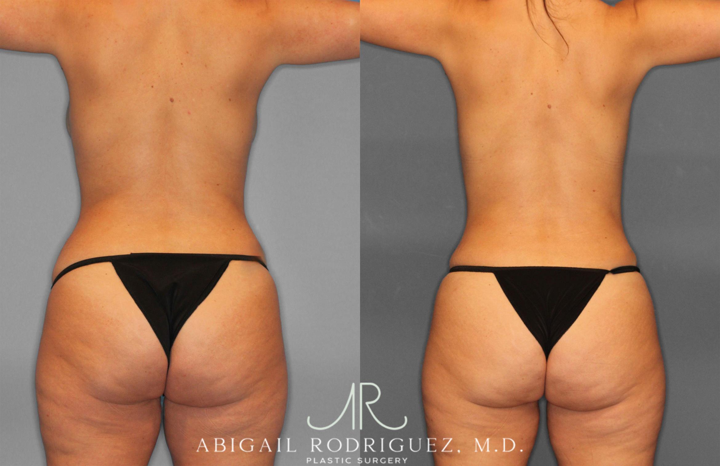 Before & After Tummy Tuck Case 258468 View 6 View in Houston, TX