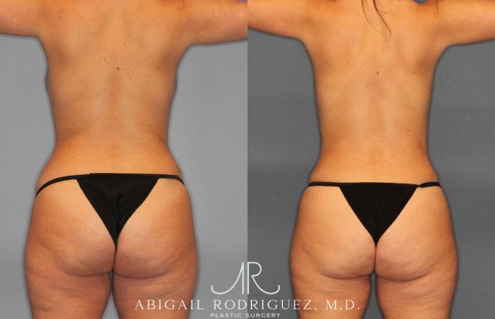 Before & After Tummy Tuck Case 258468 View 6 View in Houston, TX