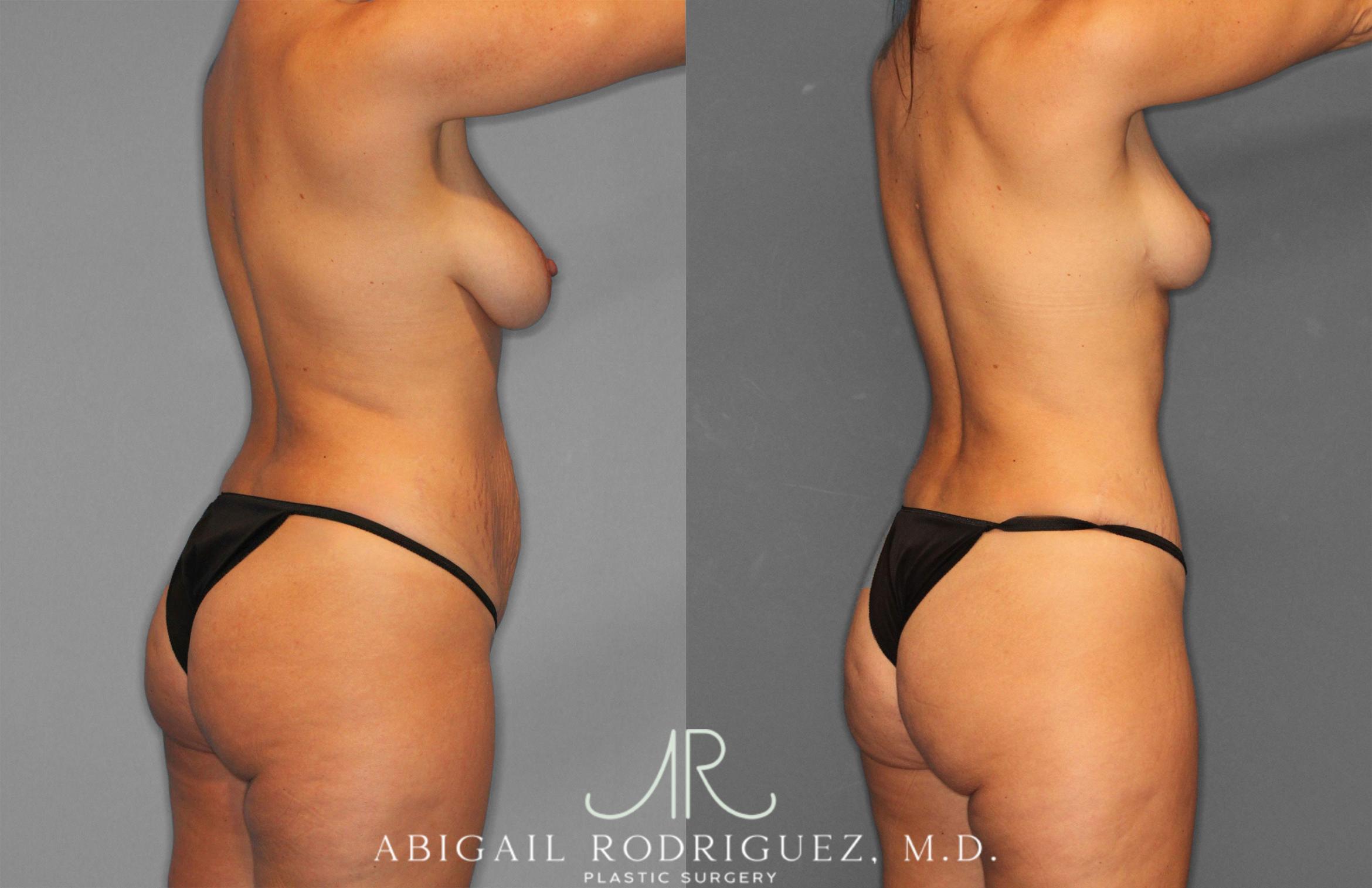 Before & After Tummy Tuck Case 258468 View 7 View in Houston, TX