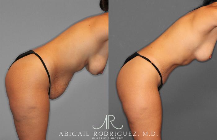 Before & After Tummy Tuck Case 258468 View 8 View in Houston, TX