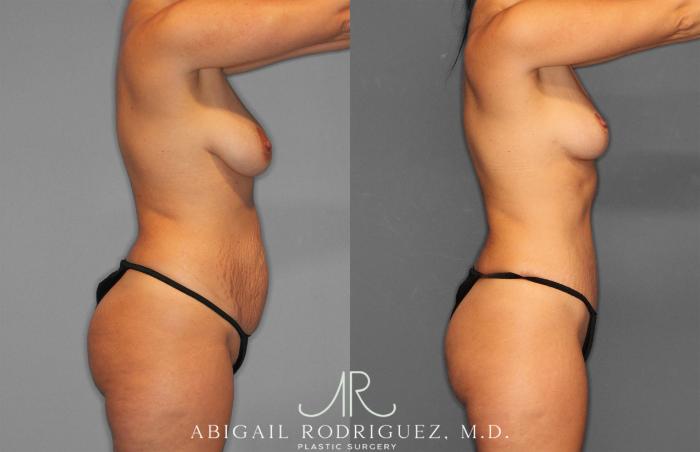 Before & After Tummy Tuck Case 258468 View 9 View in Houston, TX