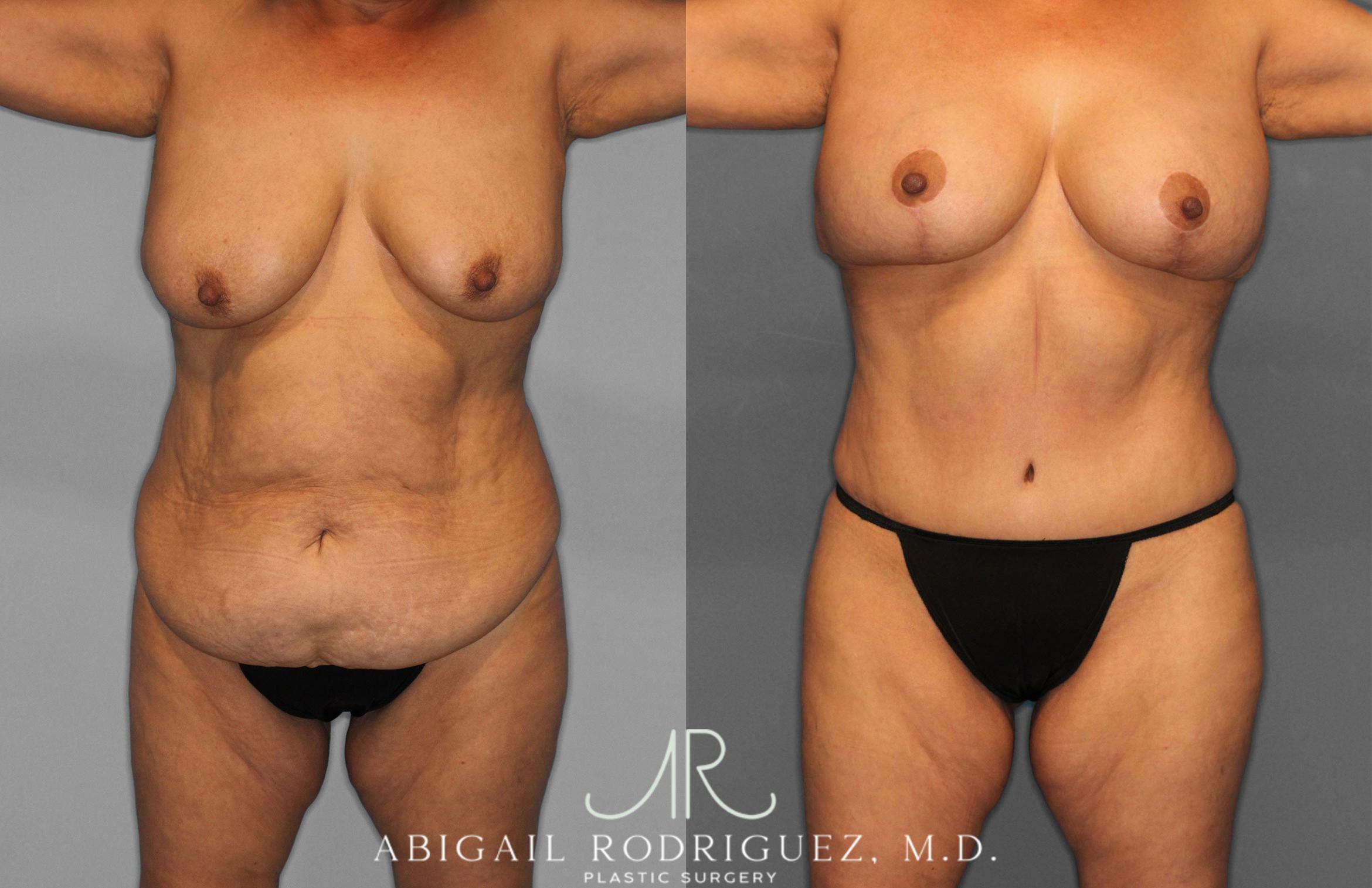 Before & After Tummy Tuck Case 258489 View 1 View in Houston, TX