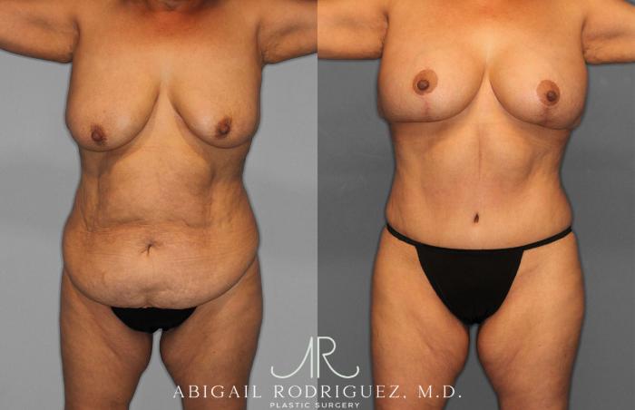 Before & After Tummy Tuck Case 258489 View 1 View in Houston, TX