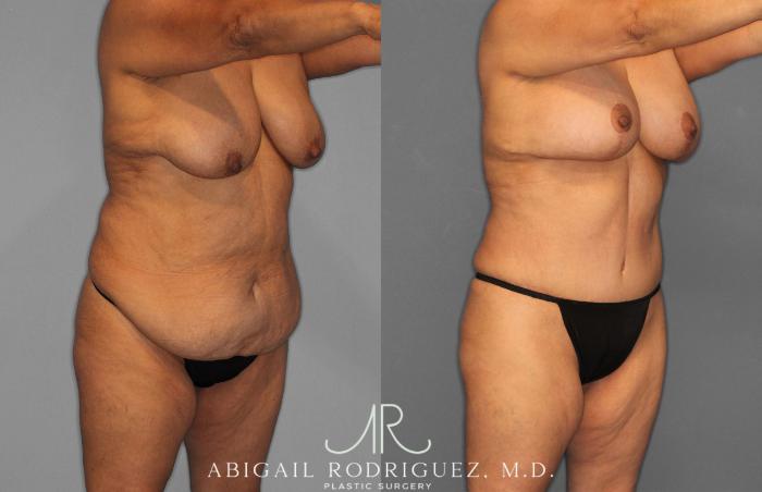 Before & After Tummy Tuck Case 258489 View 10 View in Houston, TX