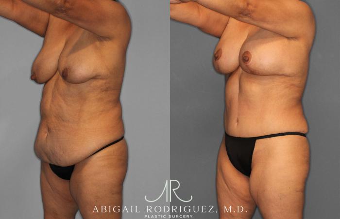 Before & After Tummy Tuck Case 258489 View 2 View in Houston, TX