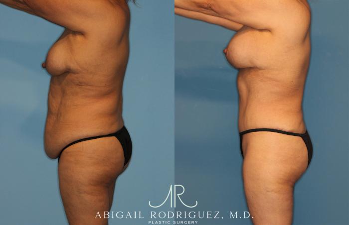 Before & After Tummy Tuck Case 258489 View 3 View in Houston, TX