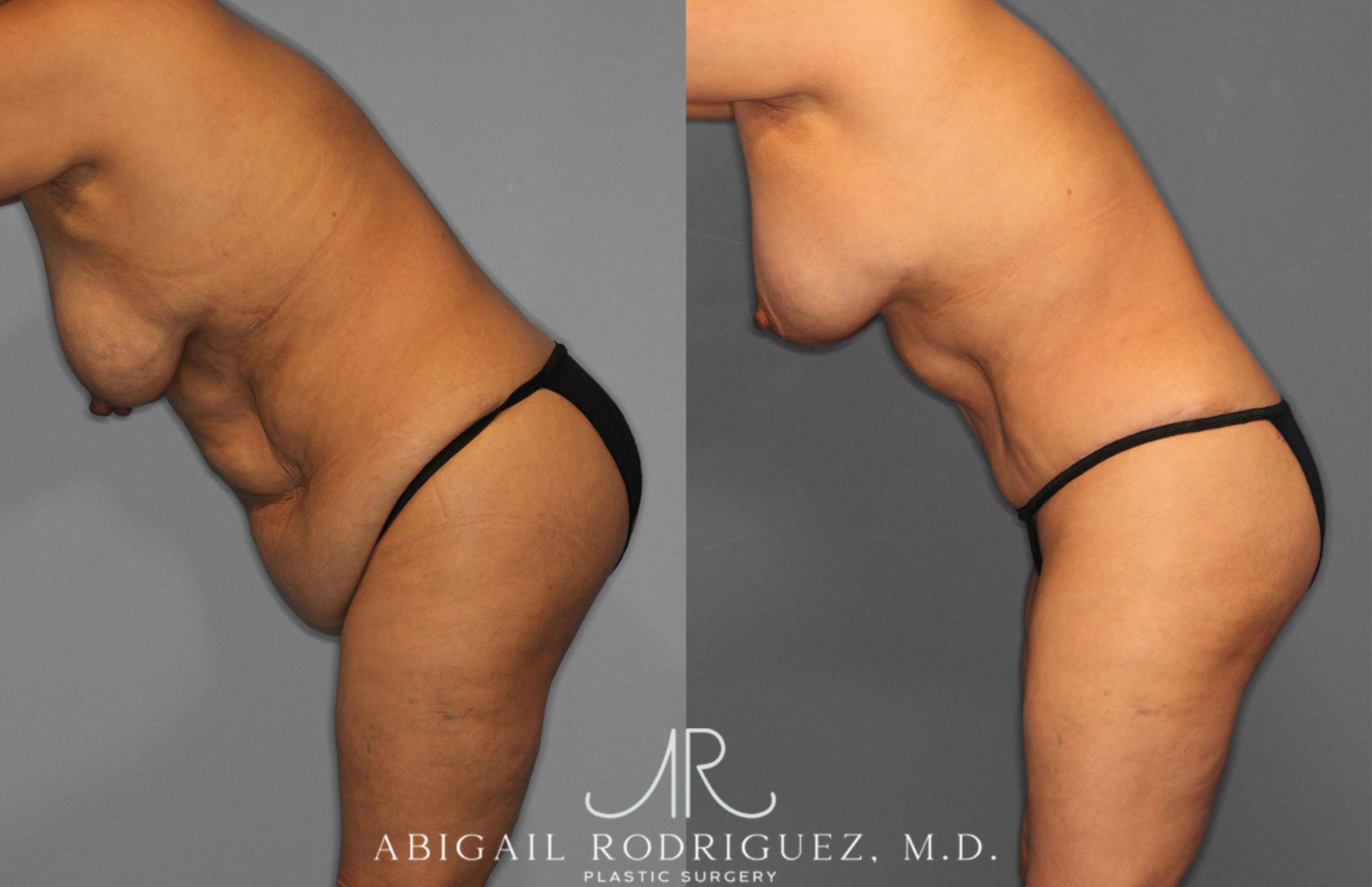 Before & After Tummy Tuck Case 258489 View 4 View in Houston, TX