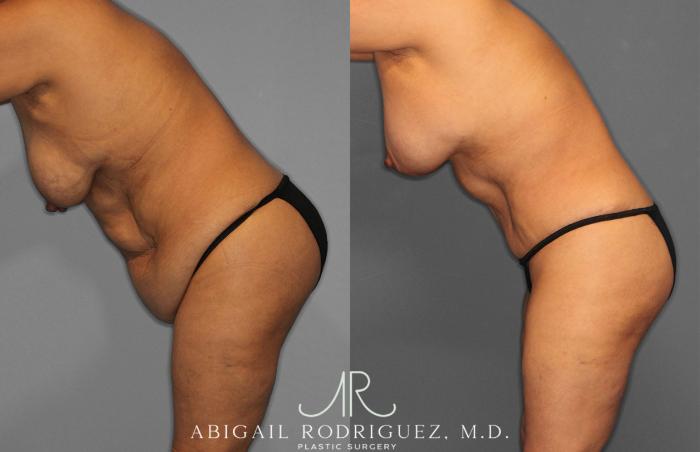 Before & After Tummy Tuck Case 258489 View 4 View in Houston, TX