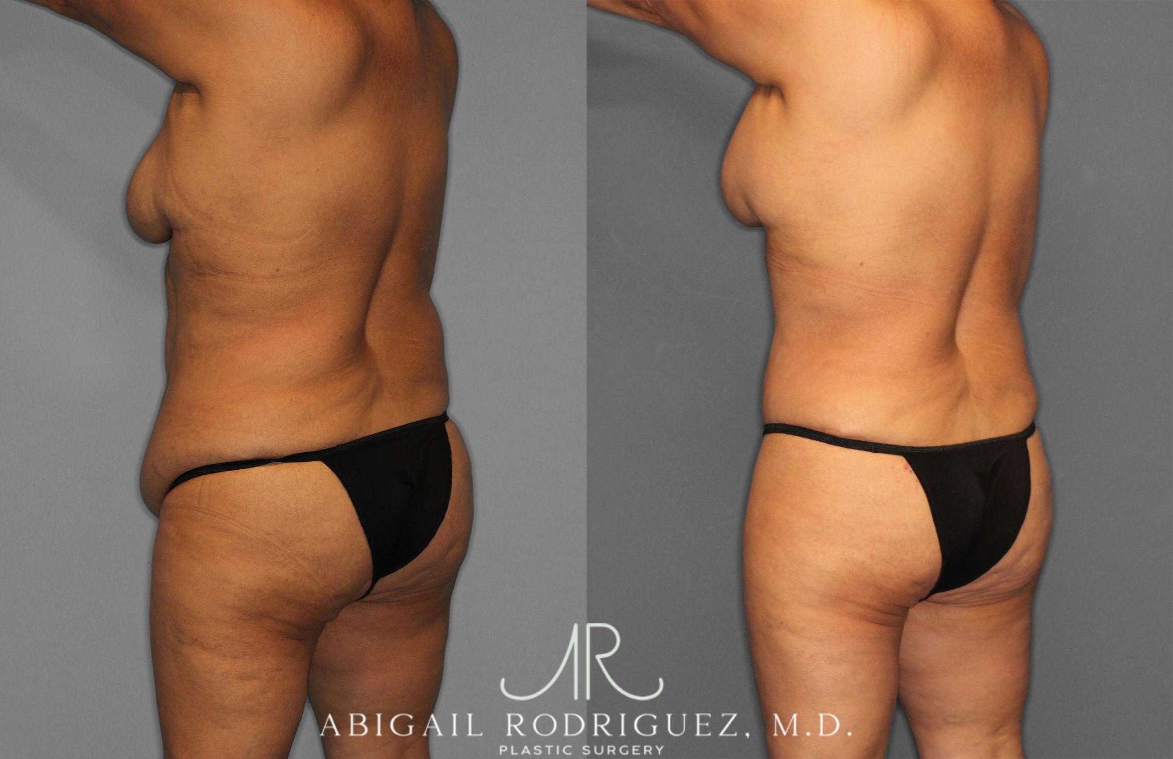 Before & After Tummy Tuck Case 258489 View 5 View in Houston, TX