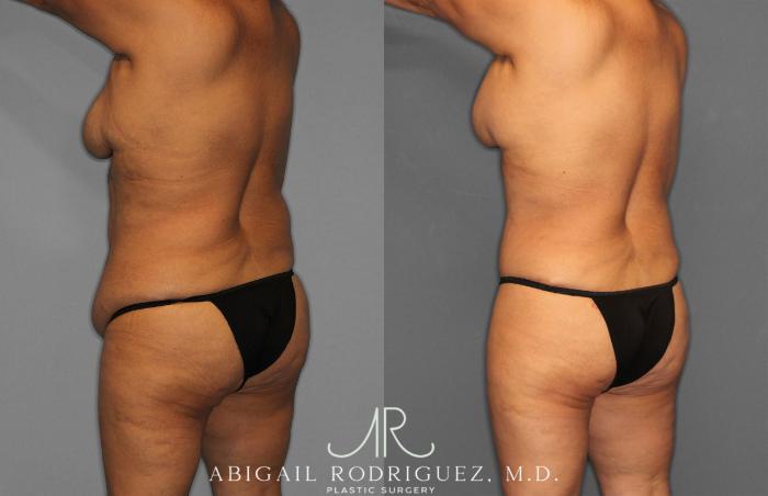 Before & After Tummy Tuck Case 258489 View 5 View in Houston, TX