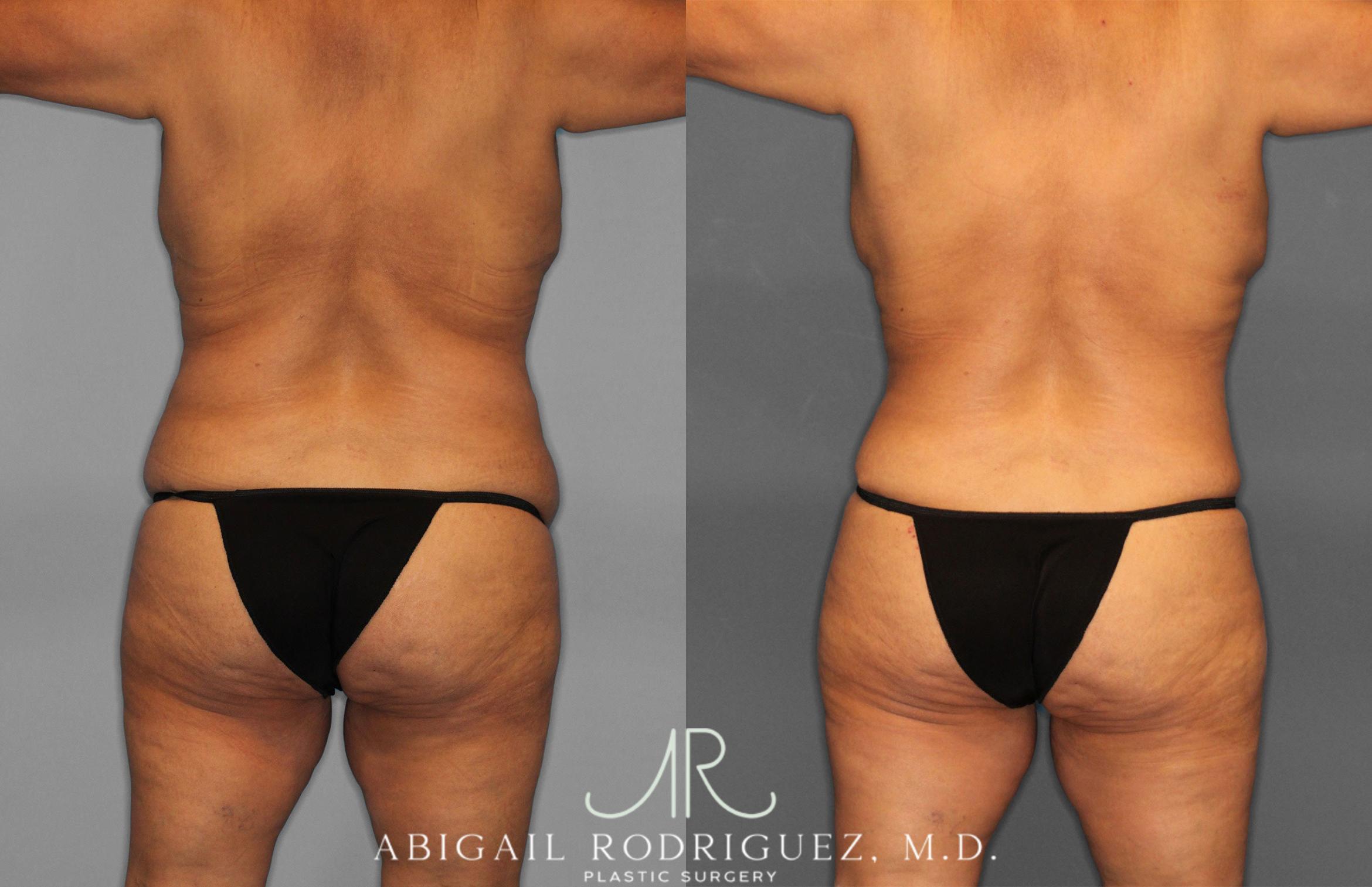 Before & After Tummy Tuck Case 258489 View 6 View in Houston, TX