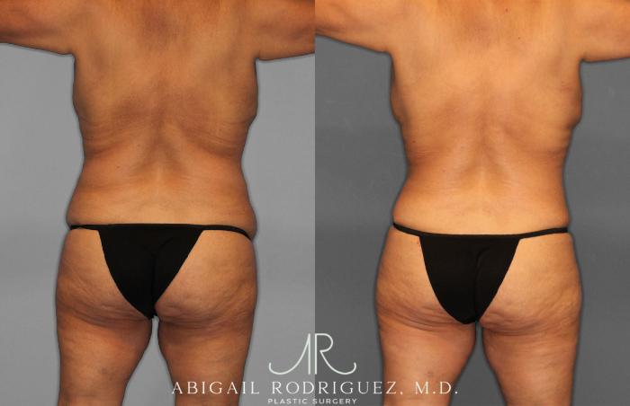 Before & After Tummy Tuck Case 258489 View 6 View in Houston, TX