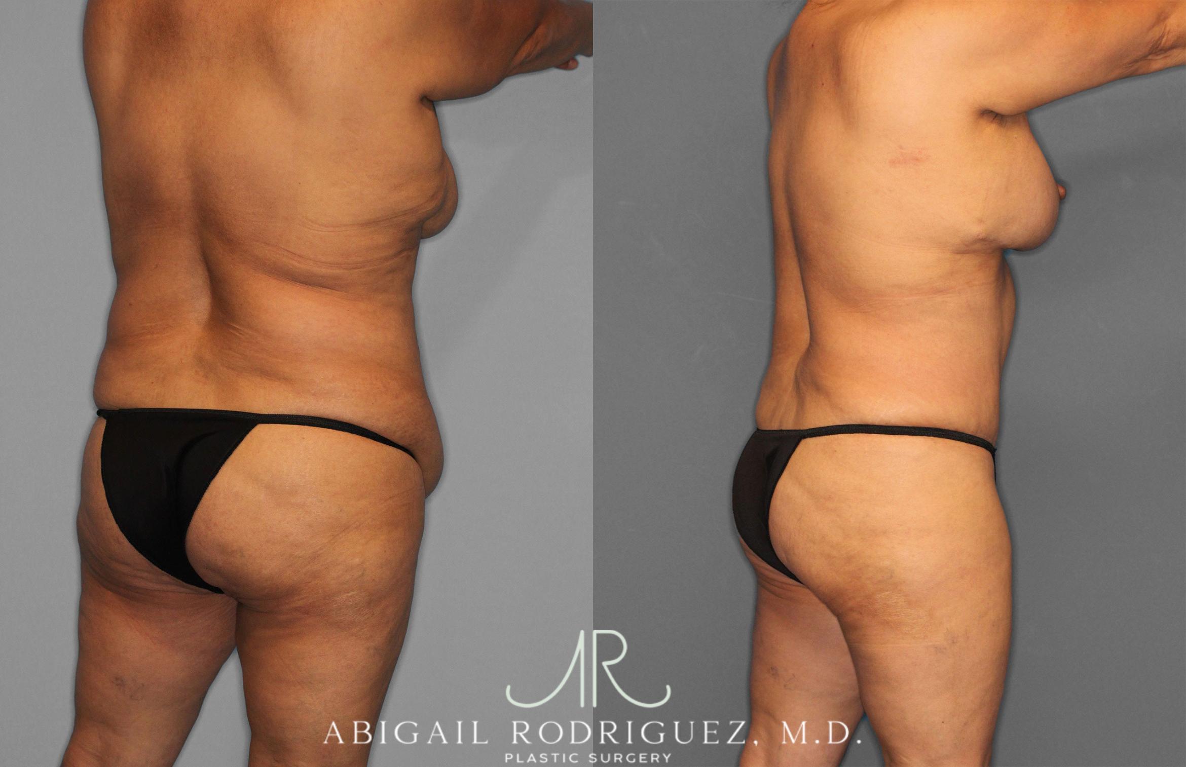 Before & After Tummy Tuck Case 258489 View 7 View in Houston, TX