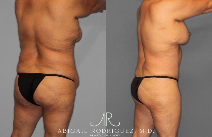 Before & After Tummy Tuck Case 258489 View 7 View in Houston, TX