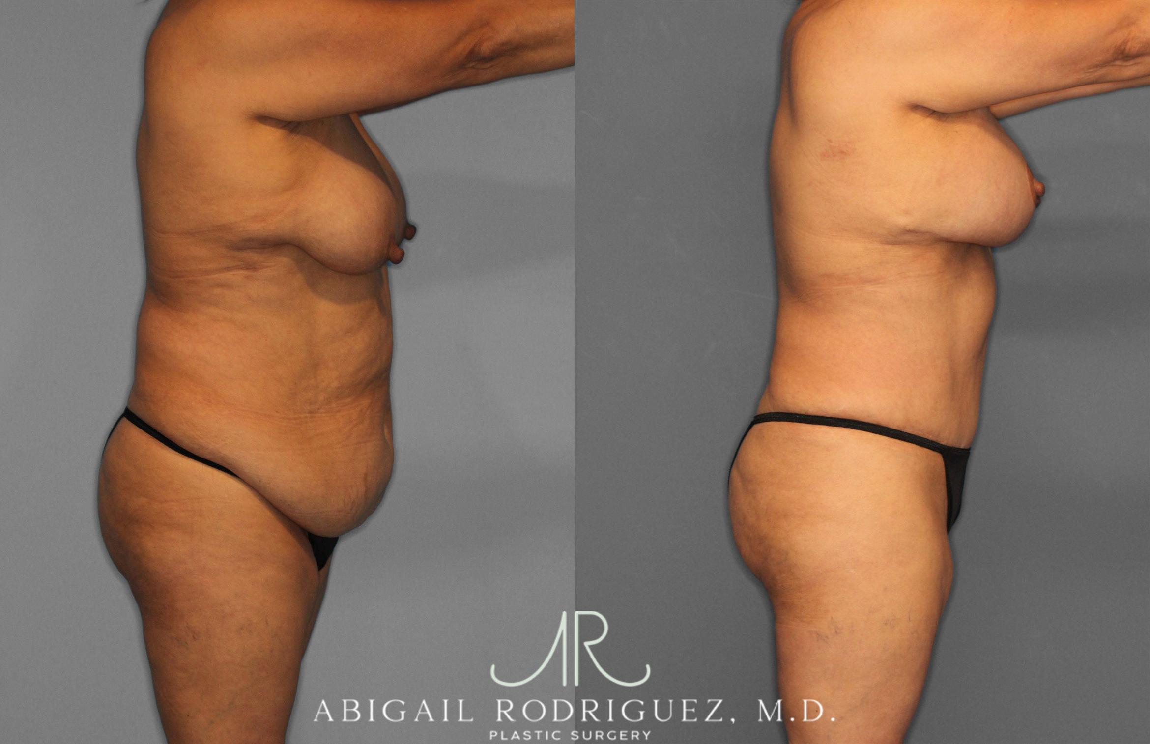 Before & After Tummy Tuck Case 258489 View 8 View in Houston, TX