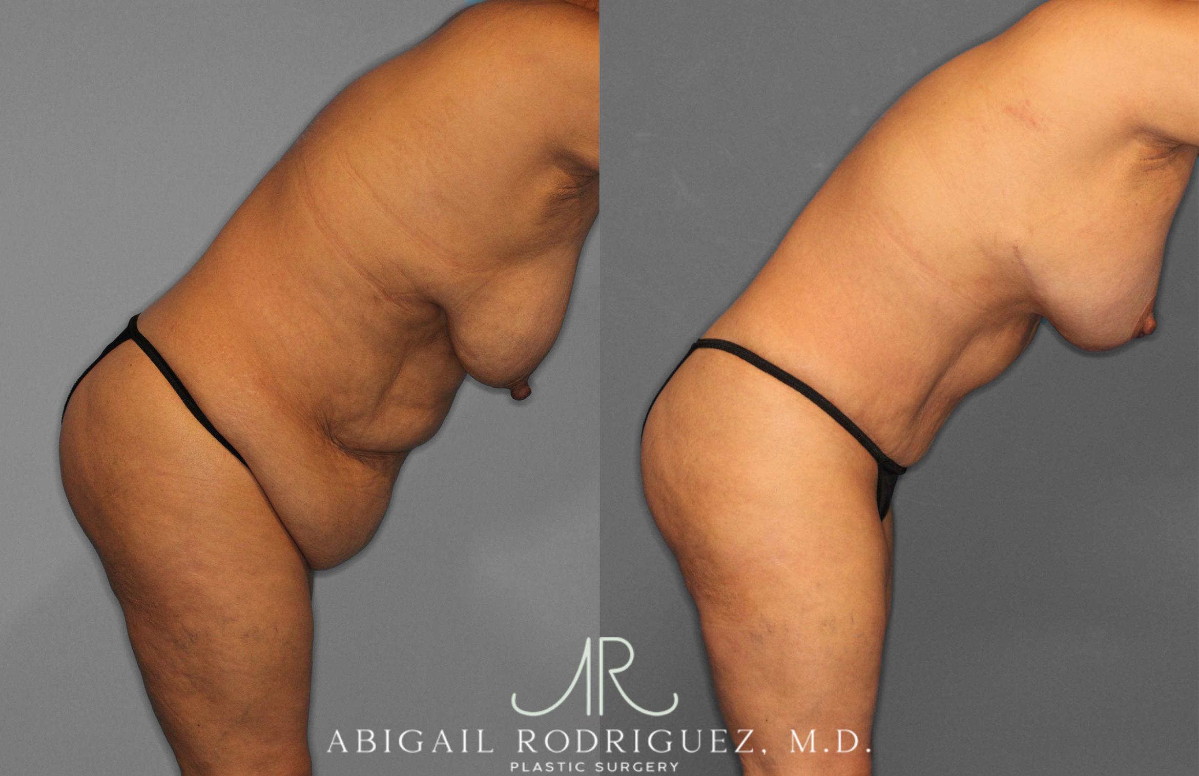 Before & After Tummy Tuck Case 258489 View 9 View in Houston, TX