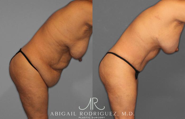Before & After Tummy Tuck Case 258489 View 9 View in Houston, TX