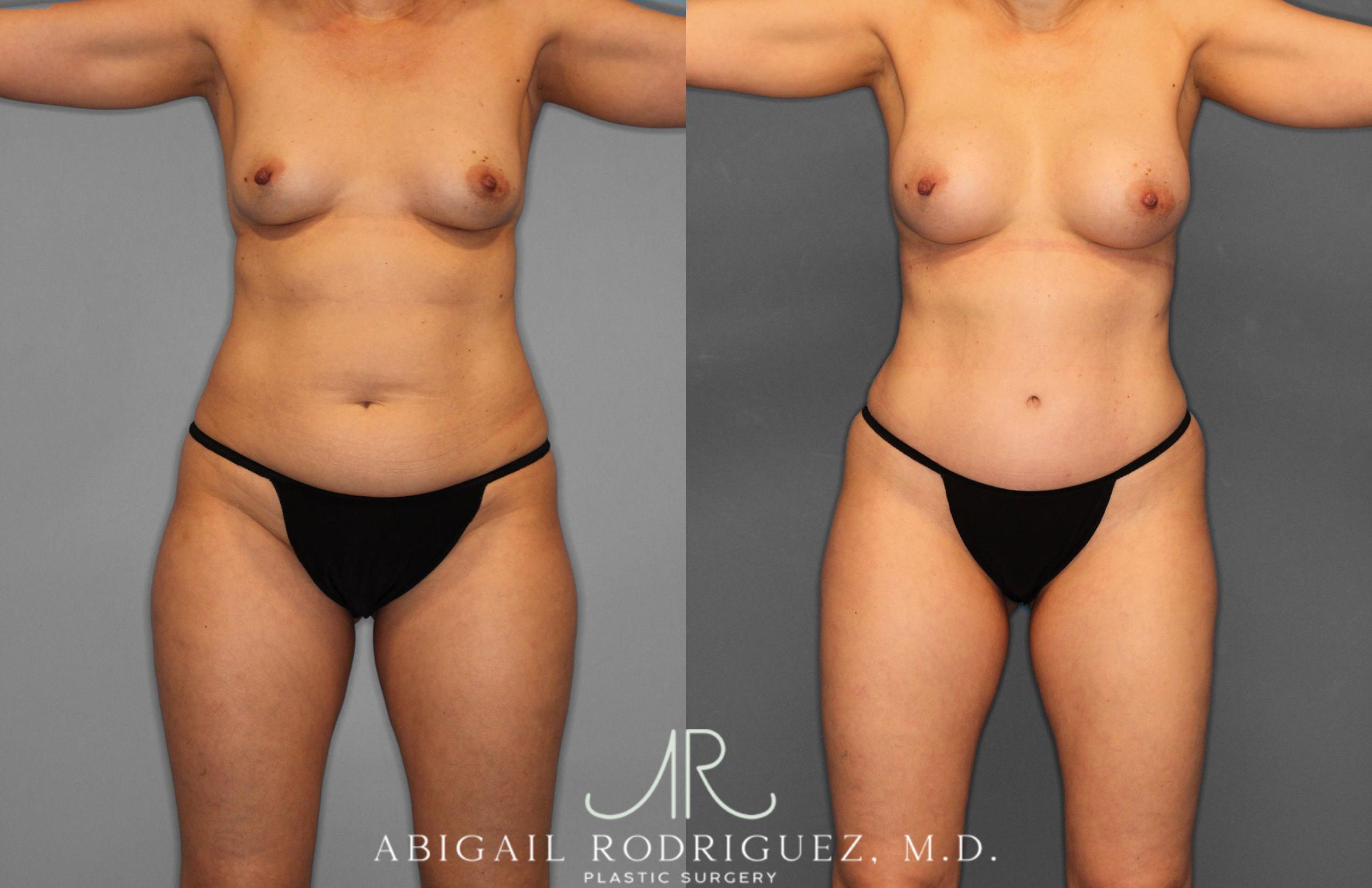 Before & After Tummy Tuck Case 258509 View 1 View in Houston, TX