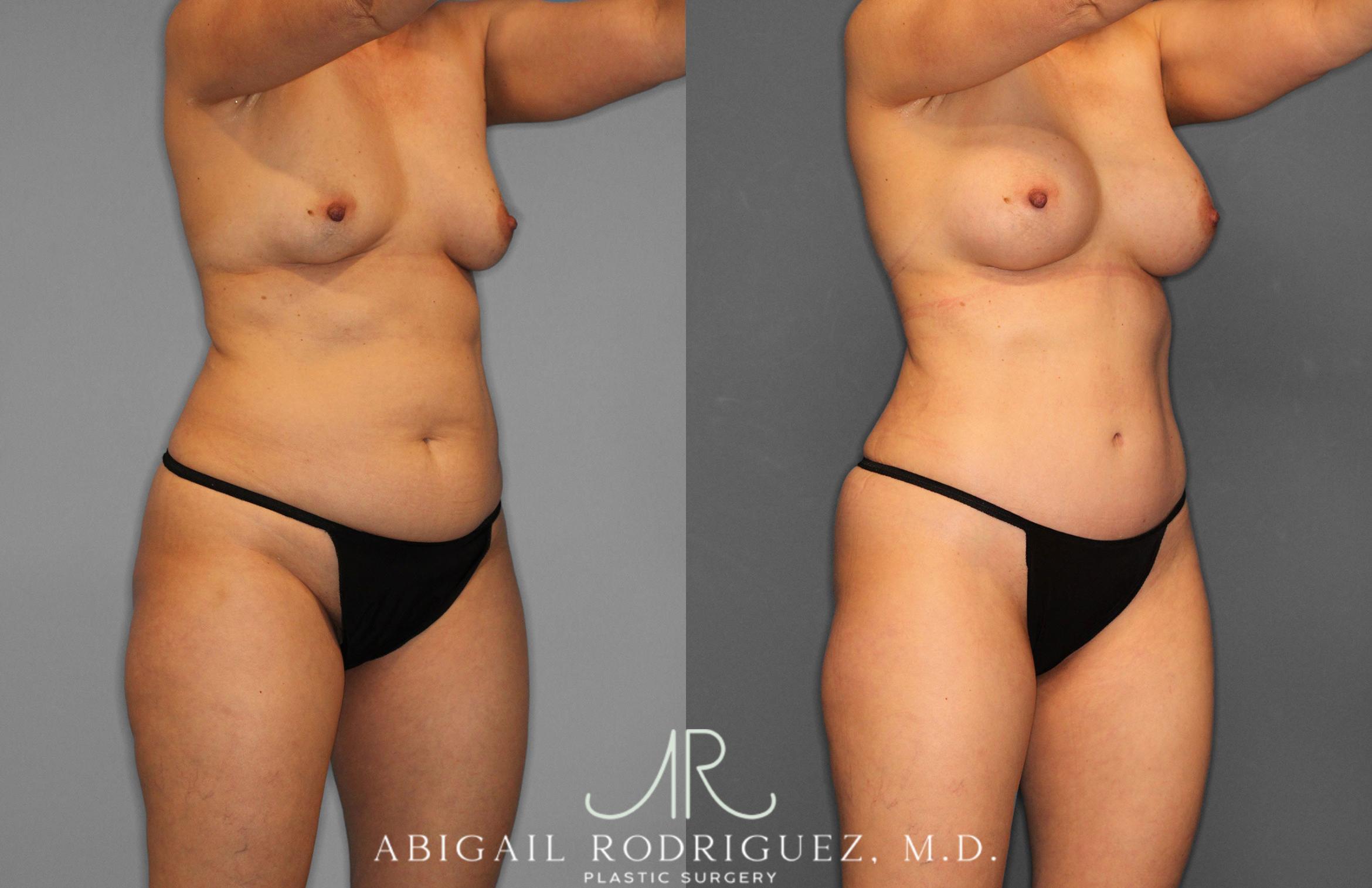 Before & After Tummy Tuck Case 258509 View 10 View in Houston, TX