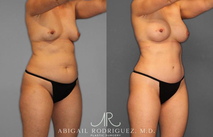 Before & After Tummy Tuck Case 258509 View 10 View in Houston, TX