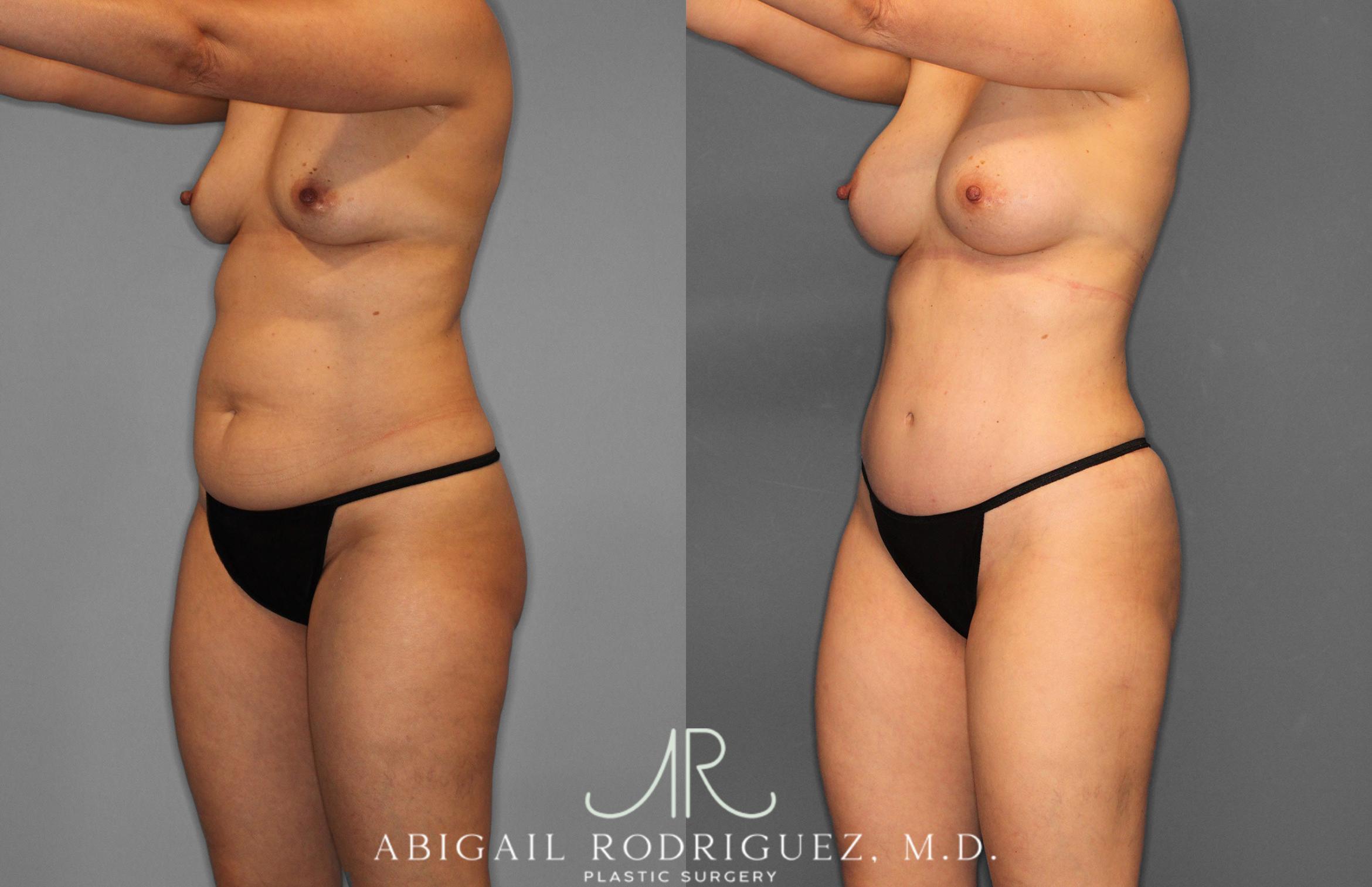 Before & After Tummy Tuck Case 258509 View 2 View in Houston, TX