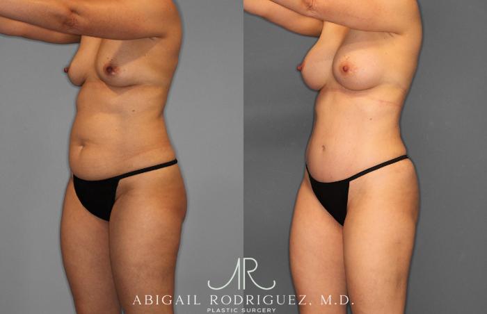 Before & After Tummy Tuck Case 258509 View 2 View in Houston, TX