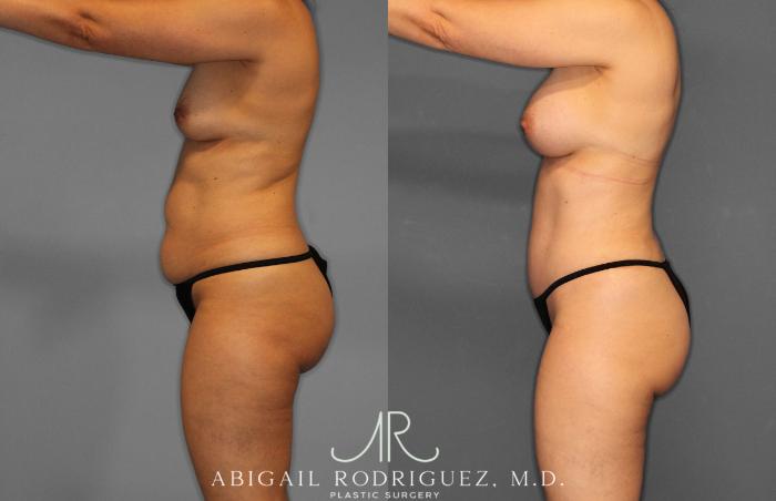 Before & After Tummy Tuck Case 258509 View 3 View in Houston, TX