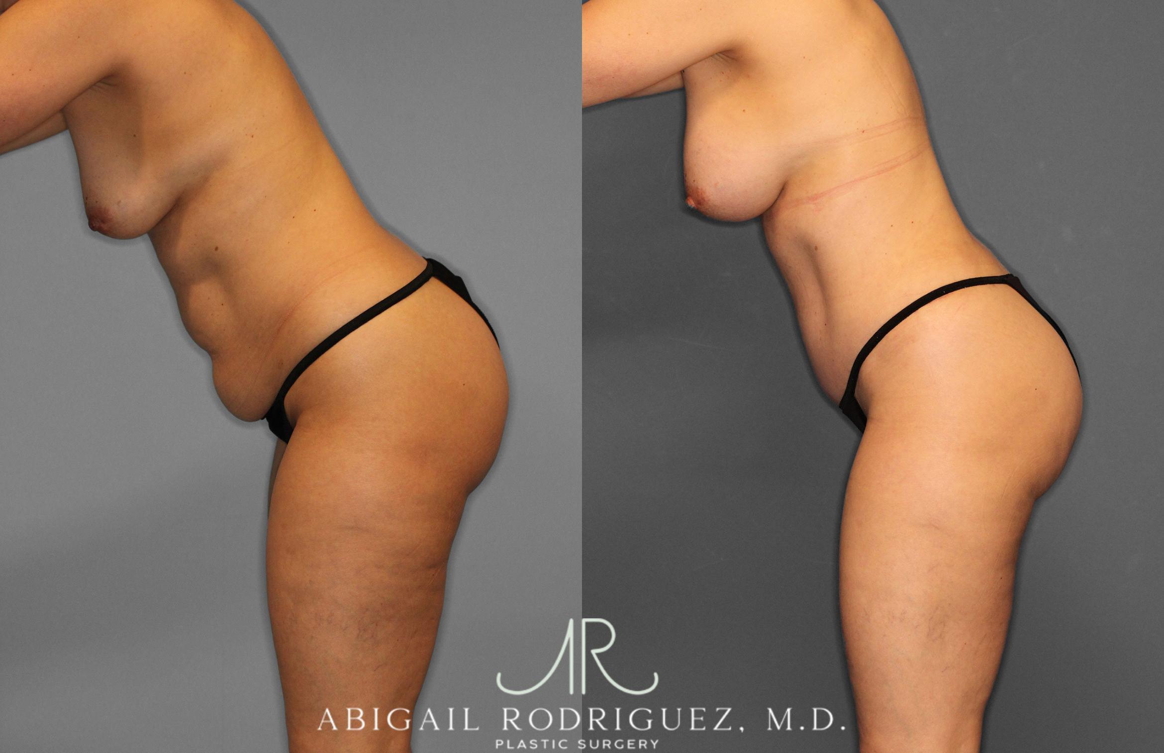 Before & After Tummy Tuck Case 258509 View 4 View in Houston, TX