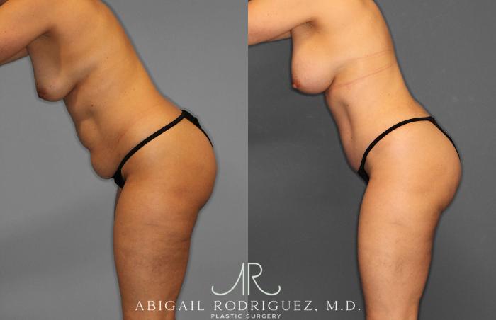 Before & After Tummy Tuck Case 258509 View 4 View in Houston, TX