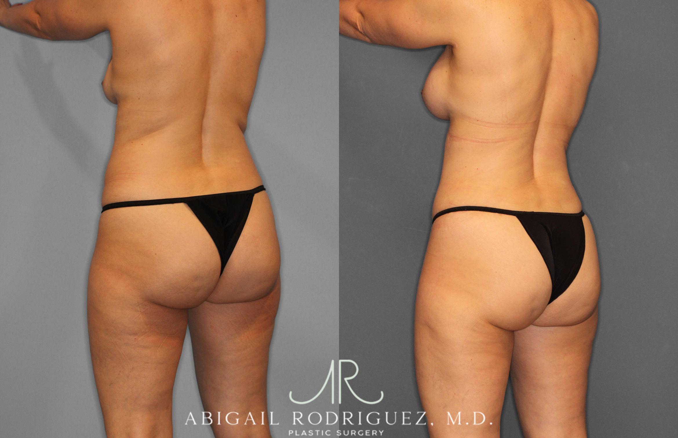 Before & After Tummy Tuck Case 258509 View 5 View in Houston, TX